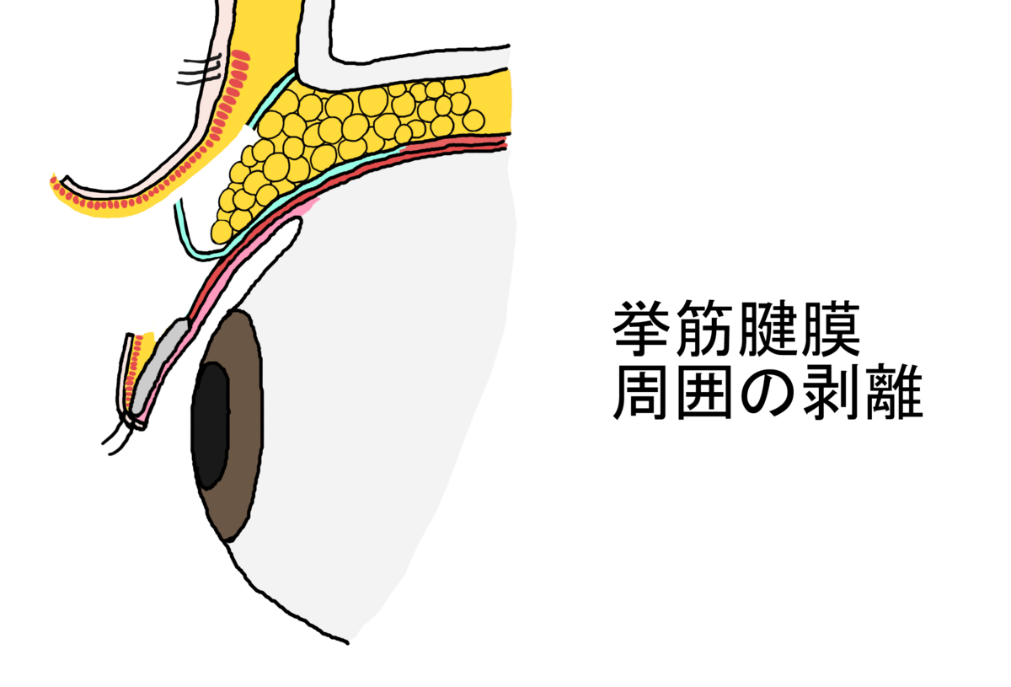 周囲の剥離