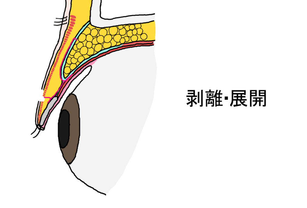 剥離・展開