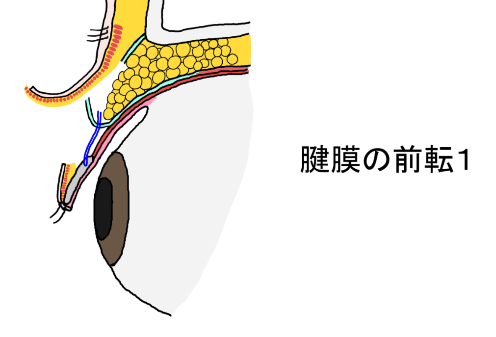 前転2