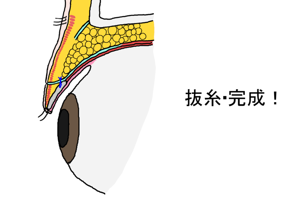 抜糸